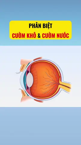 Cườm khô và cườm nước có phải là một bệnh #cuomkho #cuomnuoc #ducthuytinhthe #tangnhanap #glocom #thiendauthong #glaucoma #minhnhankhang #chamsocmat #LearnOnTikTok 