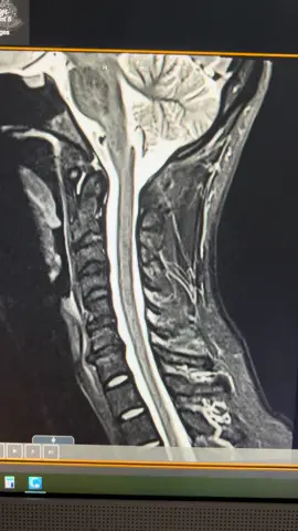 MRI of the neck. #mri #magneticresonanceimaging #neck #neckpain #pain #neckmri #cervicalmri #atlantoaxialinstability #craniocervicalinstability #aai #cci 