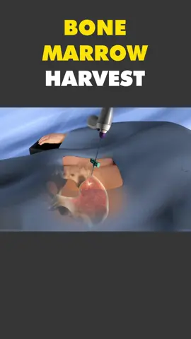Bone Marrow Harvest Procedure 3D Animation #bonemarrow #bonemarrowharvest #bonemarrowtransplant #bonemarrow #bonemarrowprocedure #medical3danimation #3dmedicalanimation #medicalprocedure 