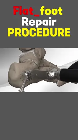 Flatfoot Repair #Flatfoot #flatfooting #Repair #treatment #for #surgery #3danimation #watch #foryou #foryourpage