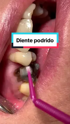 Así luce un diente completamente podrido. En estos casos, ya no hay ningún tratamiento que pueda hacerse, pues no hay ningun diente sano. La extracción es la única solución. #teeth #teethcleaning #teethgoals #dentista #dentistlife #dentist #tooth #dentistry #dentistryworld #cosmeticdentistry #dentalcare #dentalcareworld #dentalcaretips #odontologia #dentista #dentalassistant #dental #dentalimplants #dentalphotography #dentalphoto #dentistrylife #teeth #caries #toothdecay #tratamientodeconducto #rootcanaltreatment