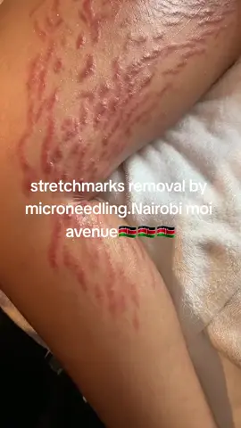 #stretchmarksremoval #microneedling #stretchmarksolution #stretchmarksremedy #fyppppppppppppppppppppppp #foryou #fypシ #fypシ゚viral #kenyanladies🇰🇪 #kenyantiktok #kenyanladies #kenyantiktok🇰🇪 #bodytransformation #skin 