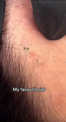 #blackhead #whiteheads #extractions #skincare #australia #singapore #indonesia #fypシ 