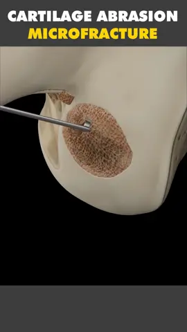 Cartilage Abrasion Microfracture Treatment 3D Animation #microfracture #microfractures #cartilageabrasion #abrasion #kneefracture #kneetreatment #kneecapsurgery #kneesurgeryrecovery #kneesurgerycheck #medical3danimation #3dmedicalanimation 