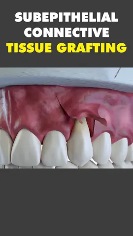 Subepithelial Connective Tissue Grafting Procedure 3D Animation #tissuegraft #tissuegrafting #connectivetissuedisorder #connectivetissuegraft #connectivetissuegrafts #medical3danimation #3dmedicalanimation #dentalprocedure #dentalsurgery #mouthsurgery #softtissuegraft #medical3danimation #3dmedicalanimation  