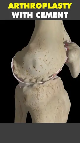 Arthroplasty With Cement 3D Animation #arthroplasty #arthroplastytotal #arthroplastysurgeon #kneearthroplasty #kneesurgery #bonesurgery #arthritisrelief #arthritis #arthritistreatment #arthritistreatments #medical3danimation #3dmedicalanimation 