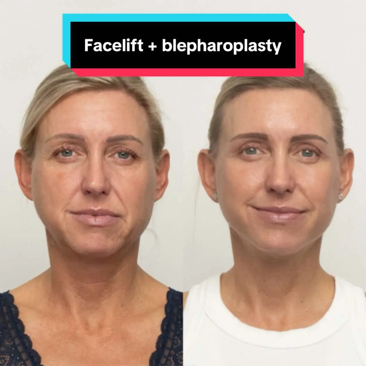 6 weeks after surgery🪄✨ What do you think?😉 #facelift #blepharoplasty #plasticsurgery #plasticsurgeon #deepfacelift #transformation #beforeandafter 