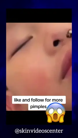 This content is original content. Copying and use elsewhere is prohibited. Thanks 💖 #skin #skincare #skincareasmr #asmr #health #skincareroutine #acne #scarring #acneskin #satisfying #pimple #satisfyingvideo #pimplepop #foryou #longervideo