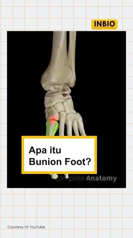 Apa itu Bunion Foot?