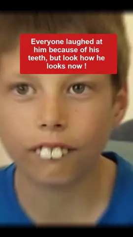 Everyone laughed at him because of his teeth, but look how he looks now! #truestories #truestoriesforyou🤗 #truestoriesforyou #truestory #LearnOnTikTok #learnwithtiktok