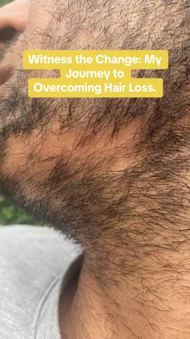 ⚡️💫The best product that fixed my hair loss⚡️💫  #fyp #foryou #trending #viral #hairloss #hairlossremedy #hairlosssolutions #haircare #menhair #rosemaryoil #desi #asianboy #punjabi #hairpatches #thinhair 