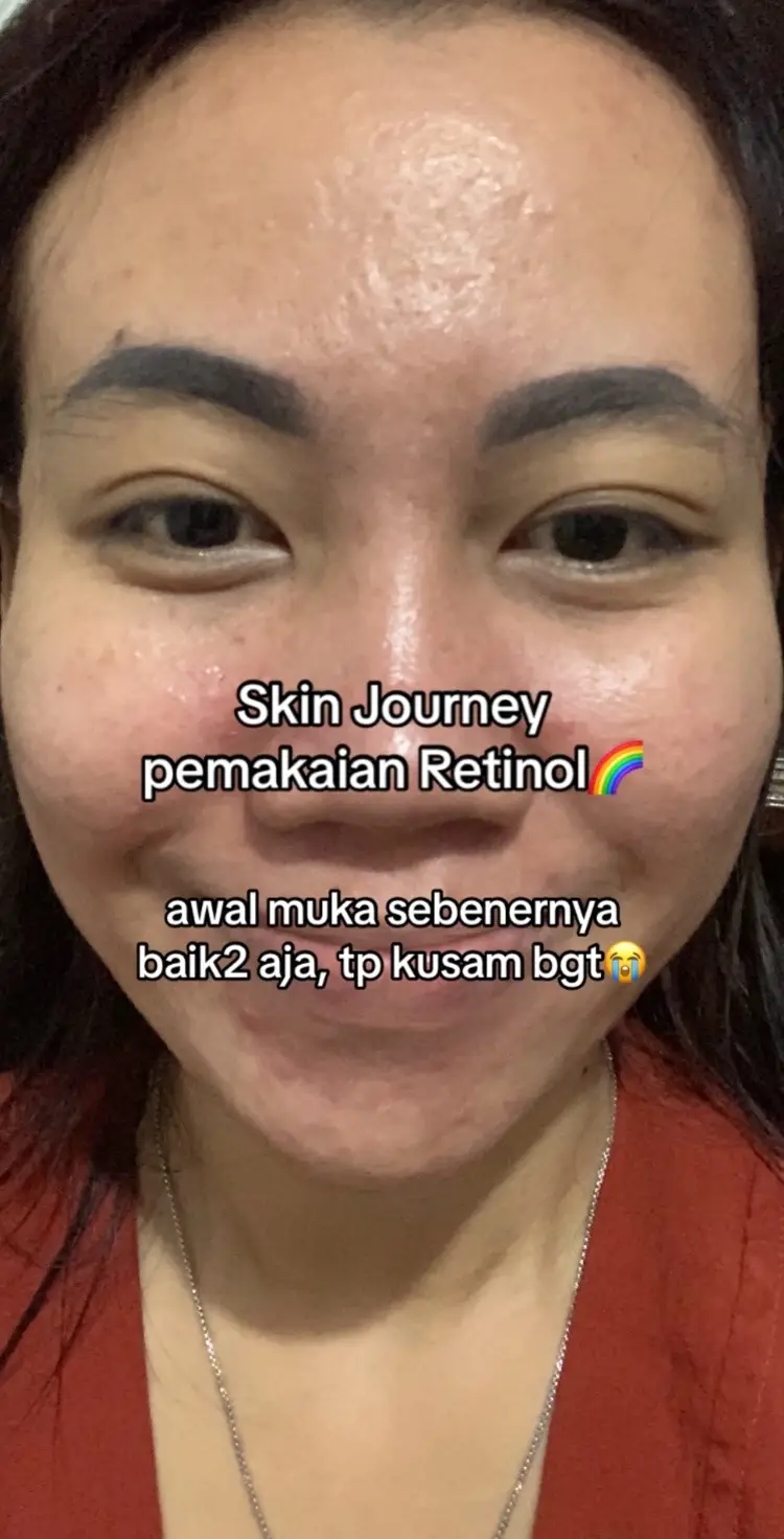 jd glowing kata gua teh lu hrs coba😡 kalo purging jgn panik sambil diselingin obat jerawat ya guys🥰 #retinol #retinolskincare #kulitglowing #retinolpemula #mencerahkankulit #memudarkanflekhitam #cerahglowingtanpalaser #fyp #fypシ 