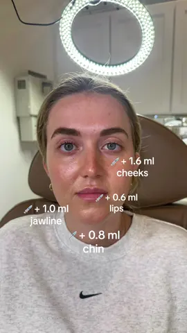 A perfect example of how a little filler in the right placed makes all the difference. Full facial balancing treatment by 😍@Callie Peraj, APRN, FNP-BC #nurseinjector #nurse #nurses #nursingschool #facialbalancing #facialbalancingfiller #filler #dermalfiller #facialbalancingwithfiller #facialbalancing #lipfiller #lipfillers #jawline #jawlinefiller #chinfiller #cheekfiller #beforeandafterfiller #beforeandafter #atxmedspa #austinmedspa #sanantoniomedspa #theinjectionroom #injectionroomsa  Lips- Kysse 0.6ml Cheeks- RHA4 1.6 ml Chin- RHA4 0.8 ml Jawline- Volux 1 ml