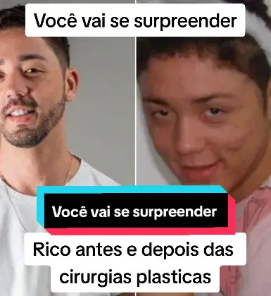 Rico antes e depois das cirurgias plasticas. #rico  #ricoafazenda  #antesedepois  #piloto 