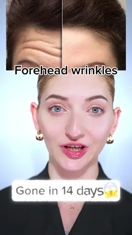 Forehead wrinkles gone in 14 days #faceyogaexercises #facetransformationchallenge #nobotoxneeded #nobotoxneeded #foreheadwrinkles #foreheadwrinkle #facefitnesschallenge #facefitnessexercise 