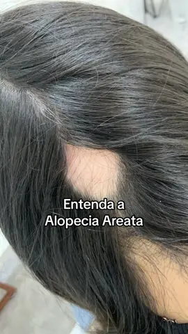Você conhece alguém com falhas circulares no couro cabeludo ou outras regiões do corpo? A alopecia areata tem se tornado cada vez mais comum. Por isso, é importantíssimo que essas informações sejam espalhadas por aí! 🙌🏼🤍 #alopecia #alopeciaareata #quedacapilar #quedadecabelo #tricologia #terapiacapilar #crescimentocapilar #cabelosaudavel #tratamentocapilar 