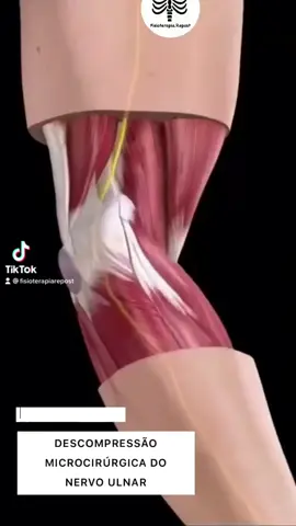 A síndrome do túnel cubital é uma doença onde o nervo ulnar sofre uma compressão na região de dentro/interna do cotovelo. O túnel cubital é formado por estruturas ósseas e ligamentares que em conjunto formam um túnel por onde o nervo ulnar passa. O nervo ulnar transmite a sensação e a função motora ao antebraço e à mão. Para os casos mais iniciais, sem sinais de atrofia da mão, é iniciado tratamento não cirúrgico, com uso de antiinflamatória, compressa de gelo e fisioterapia. O paciente também deve evitar ficar com cotovelo dobrado por muito tempo. Já nos casos em que o tratamento não cirúrgico não apresentou bons resultados e nos que há sinais de atrofia da mão indicamos tratamento cirúrgico. A descompressão microcirúrgica é indicada para liberar a pressão e evitar a perda de força da mão. #síndromedonervocubital #fisio #fisioterapia #nervocubital #med #anatomia #anatomy #cotovelo #fisioterapeuta #anatomia #sindromedonervocubital #fisioterapia #educacaofisica #fr♿ 