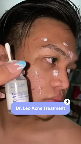 Say Goodbye to Acne ! Dr. Leo 24 hours Salicylic Acid Acne Treatment Drying Lotion ! Pimples no more ! Available sa yellow basket kaya i check out mo na yarn ! @Dr.Leo-Philippines02 #drleo #acnetreatment #salicylicacid #acne #drleoacnedryinglotion #acnetreatment #acneskin #BeautyTok #tiktokshop #TiktokShopSVChallenge #TTSBudolfinds #WoWSulitDeal 