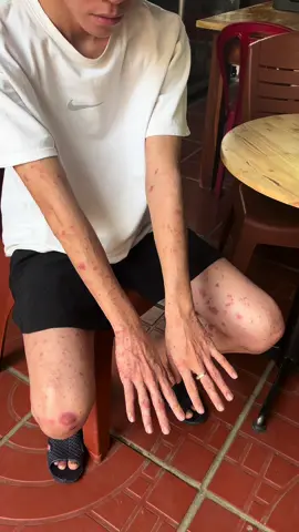 Em trai bị vẩy nến toàn người ạ #YHọcCổTruyền #thituyenxuongkhop #ongbao369 