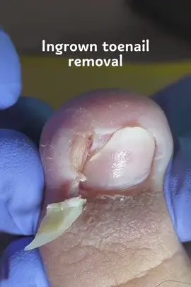 #ingrowntoenail #ingrowntoenailremoval #ingrownnail #toenails #pedicure #limpezaunhas #Онихокриптоз #fyp