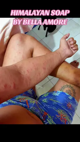 MERON PSORIASIS ANG ASAWA KO PINAGAMIT KO SIYA NG HIMALAYAN SOAP  , MADAMI KASI AKO NAPAPANOOD DITO SA TIKTOK NA GUMAGAMIT NG HIMALAYAN SOAP NA MERONG MGA SKIN DISEASE TULAD NG ECXEMA AND SPECIALY YUNG MGA MAY PSORIASIS , PINA TRY KO SA KANYA PARA IWAS FLARE UP , THANKFULLY HIYANG SIYA 😍😍😍😍 #krisalynnavarro #fypシ #himalayansoap #himalayansoapbellaamore #psoriasis #psoriasisawareness 