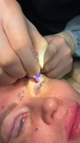 #blepharoplasty