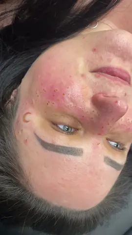 Celestial baddies stand up 🌙✨ #freckletattoo #moontattoo #cosmetictattoo #pmu #