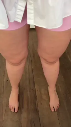 Antes e depois cirurgia de lipedema ❤️#lipedema 