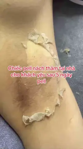 Pell thâm nách sau 5 ngày tại nhà cho khách#xuhuongtiktok #làmdepmoingay 