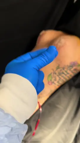 What a change! #mommymakeover #mommymakeoversurgery #mommymakeoverjourney #tummytuckjourney #lipo #tummytuck #lipoescultura #liposuction #lipo360 #breastlift #plasticsurgery #plasticsurgeon #mommymakeoverrecovery #tijuana #beautyandlightmedicalsolutions #tummytucksurgery 