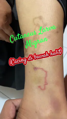 #alergi #cacing #larva #dermatitis #rsbudiasihcikarang #mindset #parasite #kulit #CapCut 