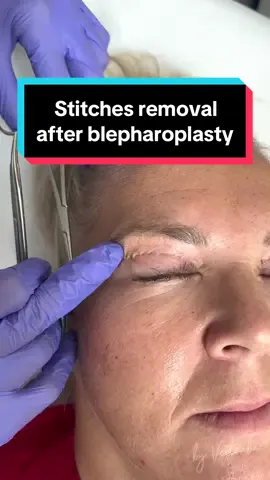 Quick and painless stitches removal after blepharoplasty👌🏻 📲You can contact me on info@v-clinic.cz #stitchesremoval #blepharoplasty #satisfying #stitches #plasticsurgery #plasticsurgeon 