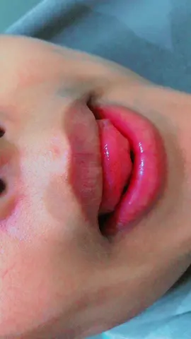 goorme laga furaa biraha ilkaha? #fyp #viral #viralvideo #foryoupage #dental #muqdisho #somalitiktok12 #nairobi #foryou #somaliatiktok 