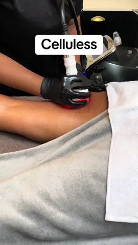 There’s no silver bullet when it comes to cellulite. But with time and investment, you can see a marked reduction. Our 4 step cutting edge treatment reduces cellulite, but will only be achieved over several sessions.  For a consultation or treatment, message us on 064 000 2021.  #cellulite #Celluless #cellulitereduction #aestheticsclinic