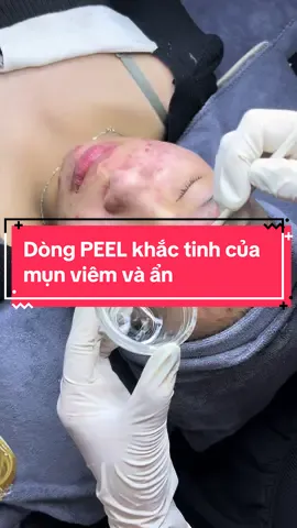 Dòng PEEL khắc tinh của mụn viêm và ẩn  #đào_tạo_học_viên  #dieutrimunchuyensauchuanykhoa # #điềutridakhoahoc  #khoápeel #xuhuongtiktok  #kimanhspa 