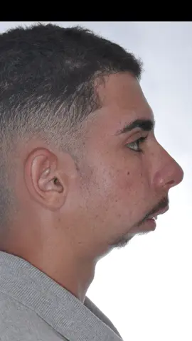 ‼️UMA JORNADA QUE SE INICIOU HÁ 10 ANOS ATRÁS‼️  👉 Foi extremamente comovente ver este vídeo do @joao_vitinho7447 na época. Na ocasião ele tinha 8 anos de idade, uma doença articular degenerativa, e nada nos impediria de lutar por esta causa.  👉 Apartir daquele momento, iniciamos uma “batalha” para podermos viabilizar o procedimento cirúrgico e permitir uma vida melhor e digna a ele.  👉 Após 10 anos de muita dedicação, finalmente vencemos!! Graças a Deus, e ao empenho de todos os envolvidos, foi possível a viabilização das próteses e então realizarmos este tão sonhado desejo de todos nós!! Agradeço a Deus todos os dias por me permitir contribuir com esta transformação de vida!! 🙏🙌💚                           👉 11 dias de pós-operatório, e o melhor ainda está por vir!! 👈 👉 “O segredo de um grande sucesso está no trabalho de uma grande equipe” #cirurgiaortognatica #ortognatica #apneiadosono #qualidadedevida #saude #bemestar #ortodontia #fonoaudiologia #otorrino #medicinadosono #transformação #antesedepois #orthognatic #jawsurgery #facialsurgery #beforeandafter #bucomaxilofacial #dentista #odontologia #dentistry #orthodontics #equipe #team  #tmjconceptsbystryker #tmjtotalreplacement #protesetotaldeatm #foryoupage #foryourpage                                obs: não temos nenhum conflito de interesse