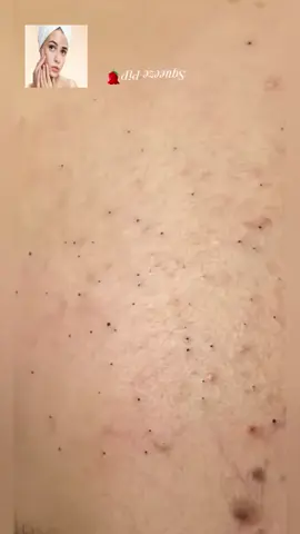 #squeeze #squeezeyuk #acne #pimple #pimplepop #blackhead #satisfying #foryoupage 149