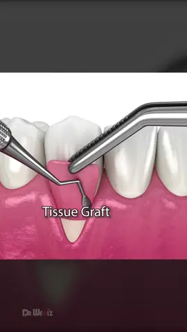 Soft Tissue Graft Surgery: In this video we’ll explain what gum recession is, it’s potential causes, and the impact it can have on oral health. Soft Tissue Graft Surgery often referred to as gum grafting, is a proven method for effectively treating gum recession. #surgery #gums #dentist 