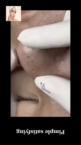 #squeeze #squeezeyuk #acne #pimple #pimplepop #blackhead #satisfying #foryoupage 193