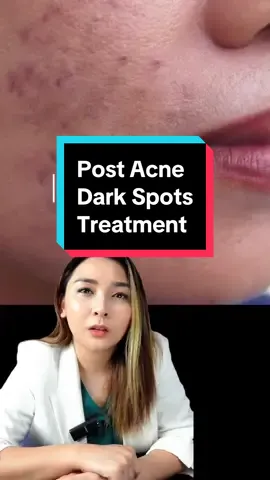 Post Acne Dark Spot Treament  🧡 . . . #skincareph #skincarephilippines   #dermtok #dermaph #tiktokmademebuythis #darkspots #whitening #pampaputi #acnespots #darkspot #hyperpigmentation #LearnOnTikTok #postinflammatoryhyperpigmentation #PIH #pampaputi #pampakinis #glowingskin #dermtok #dermtokph 
