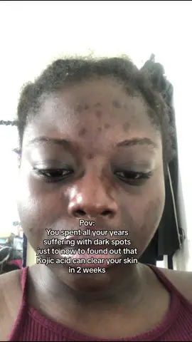 Replying to @Angels aesthetics kojic acid will change your life chilleeee. Link in bio #kojicsoap #skincarefordarkspots #tumericsoap #darkspottreatment #kojicacidsoap #scarsbegone #hyperpigmentation #kojicsoapqueen #brilliantkojicacidbodywash 