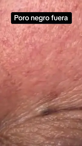 exttracion satisfactoria #extractions #puntosnegros #acne #grasa #espinillas #granos #poros #facial 