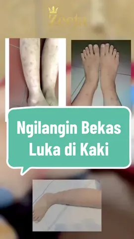 Semua ada solusi nya jadi jangan insecure🥰✨ #zeetabeautycarelampung #skincare #laser #beauty #cantik #zeetabeautycarelampung_ #fyp #klinikkecantikanlampung #fyp #facial #dnasalmon #bandarlampung #prp #nctf #treatment #klinikkecantikan 