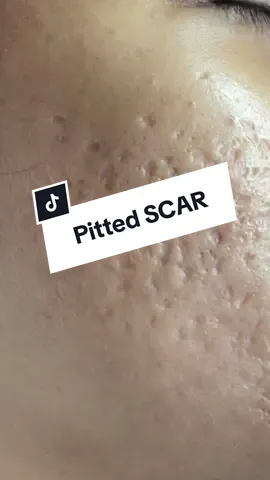 Why do you need to suffer from deep acne scars? Let me help you!! #scars #microneedling #meso #iglamandglow #bbglow #bbglowdubai #dxb #dubai_dxb_uae #facialtreatment #acnescars #acne #acnejourney #acnescar #face #facial #korean 