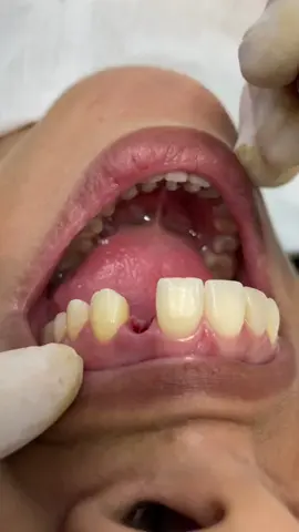 A suavidade do incisivo lateral. A implantodontia pode salvar o seu sorriso! Sorrir é para sempre. #implante #implantedental #implantodontia #natalrnbrazil #protese #brasil #implantesdentarios #natalrn🇧🇷 #odontologiaestetica #protesesobreimplantes #dentes #dentistry #odonto #drdanielcoutinho #prótese #implantesdentários #drdaniel #natalrn #implantes 