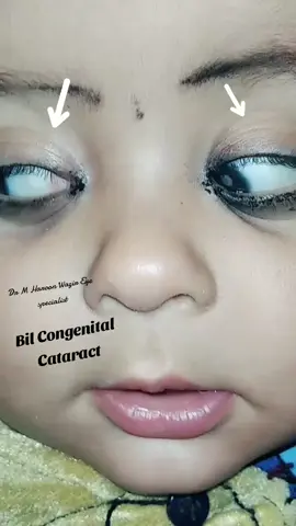 #congentialcataracts #medicaltiktoks #optometrist #ophthalmology #foruuuu #virallll #medicalfellow #virallllllllllllll #😭😭😭😭😭😭💔💔💔💔 #ik #foryouuu 