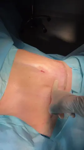 #abdominoplasty #abdominoplastia