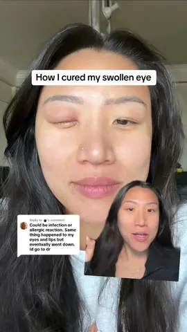 Replying to @🧉 #greenscreen HOW I CURED MY SWOLLEN EYE #swolleneye #allergy 