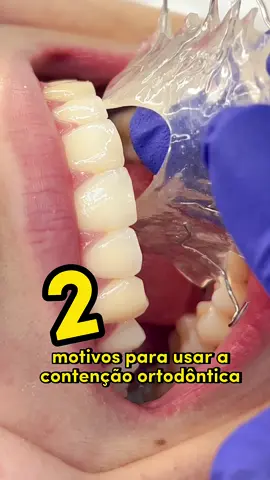 Atenção nessa dica!!! 🚨 #contencaoaparelho #aparelhomovel #vilavelhaes #vitoriae 