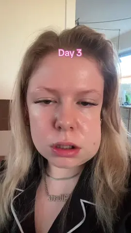 Throwback to march 2023🥹 #wishdomteethsremoved #wishdomteeth #wishdom #theworstmonthofmylife #imokaynow #dentist 